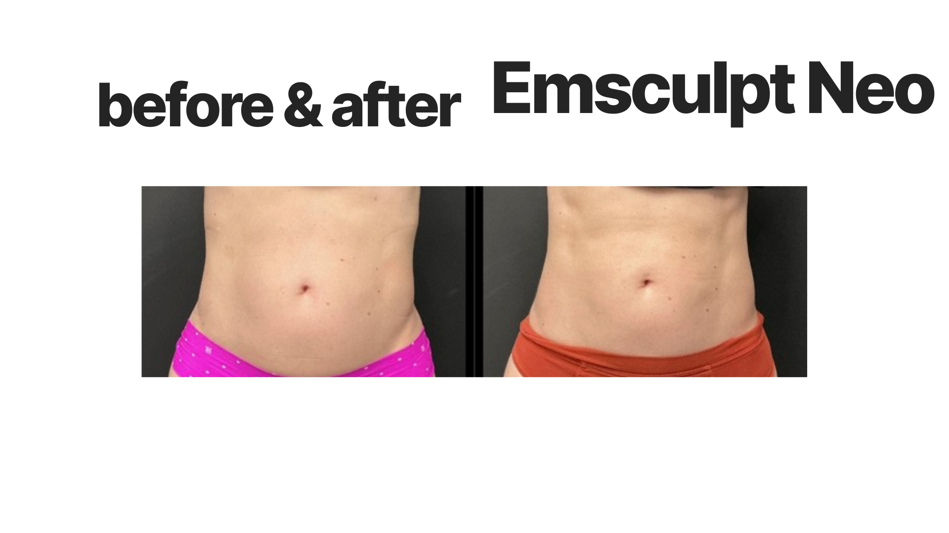 Comparison of a woman's midsection before and after Emsculpt Neo treatment, showing fat reduction and muscle toning.