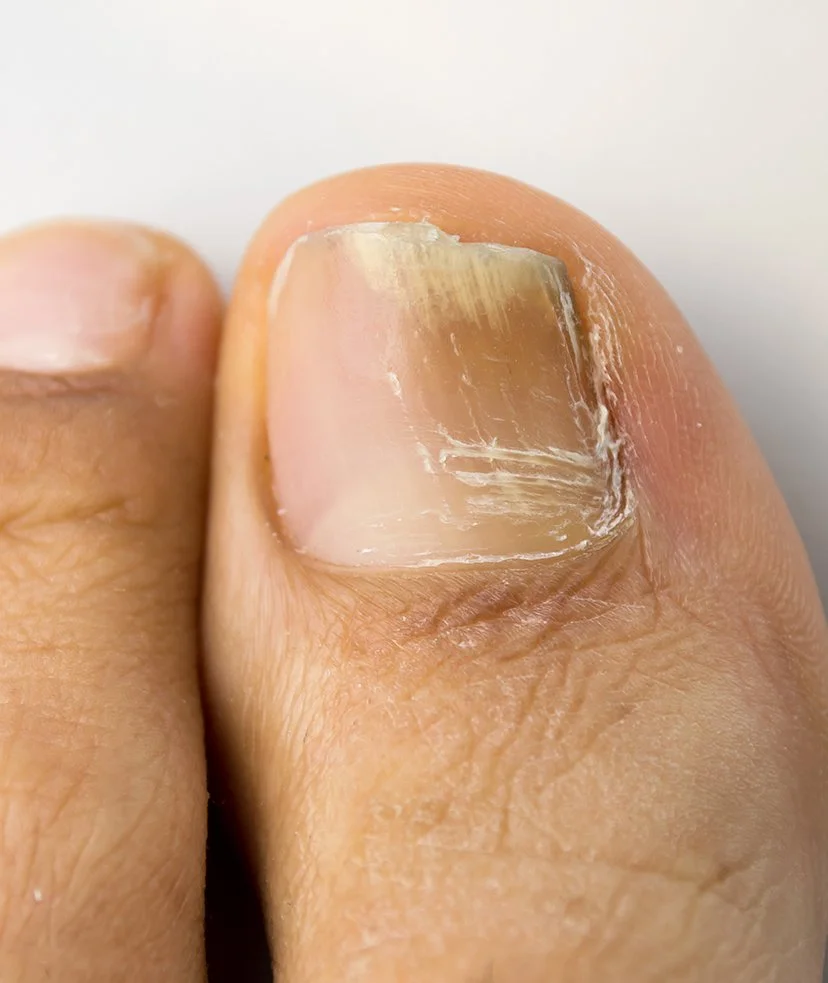 Close-up of a fingernail on a thumb showing damage, with the nail chipping and peeling from Tie Fungus.
