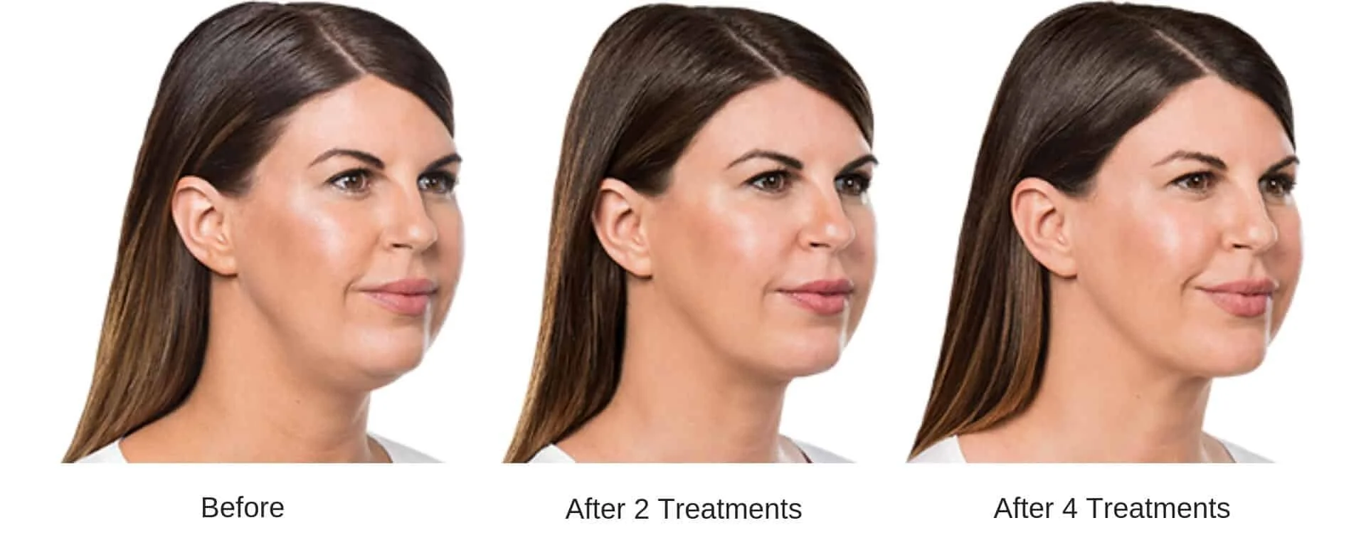 Before-and-after comparison showing a woman’s profile after two and four cosmetic treatments
