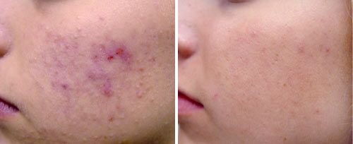 before and after of fotona acne treatment