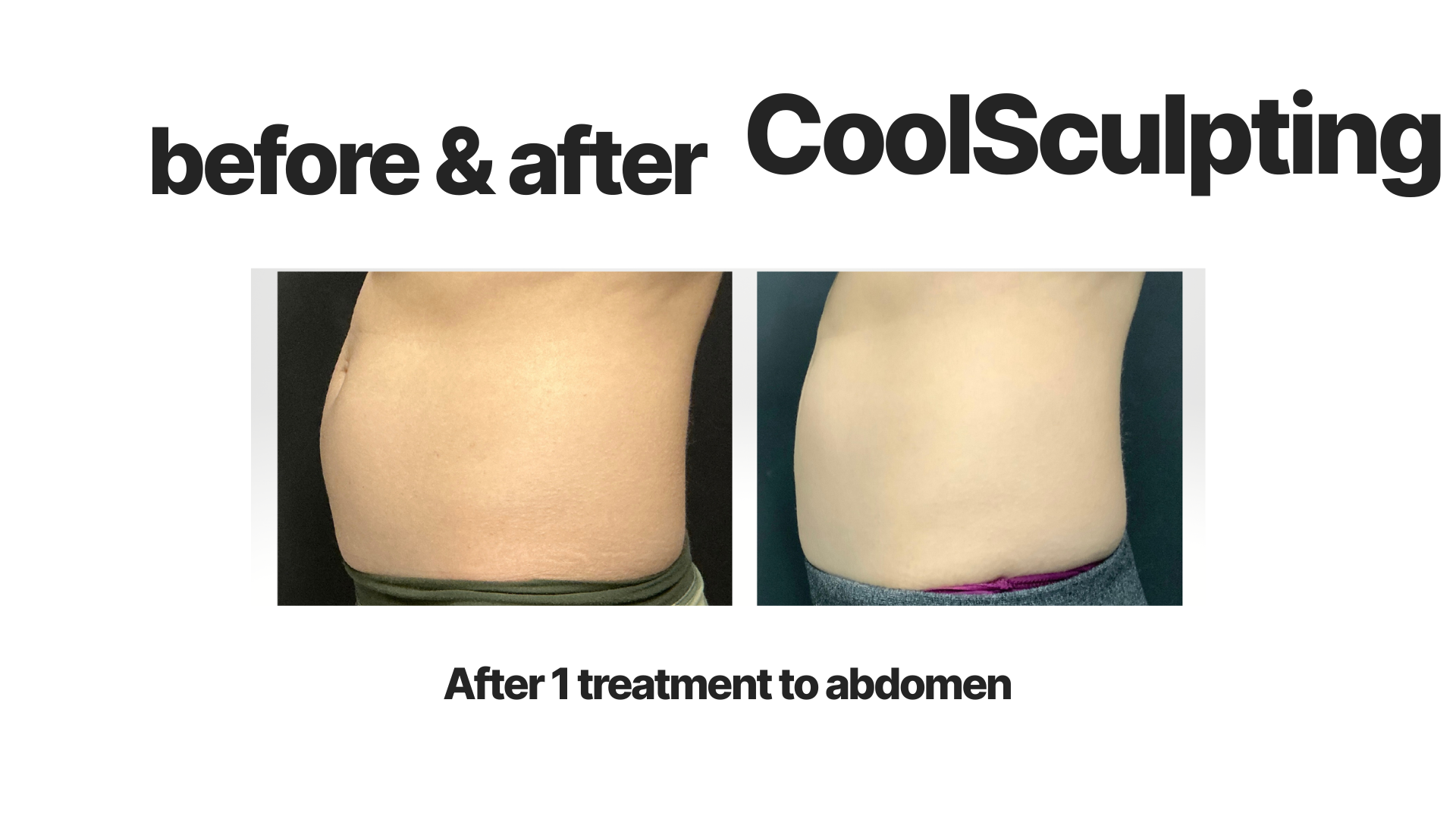 Side-by-side images of a person's abdomen, showing before and after one CoolSculpting treatment, with the after image indicating a slimmer appearance.