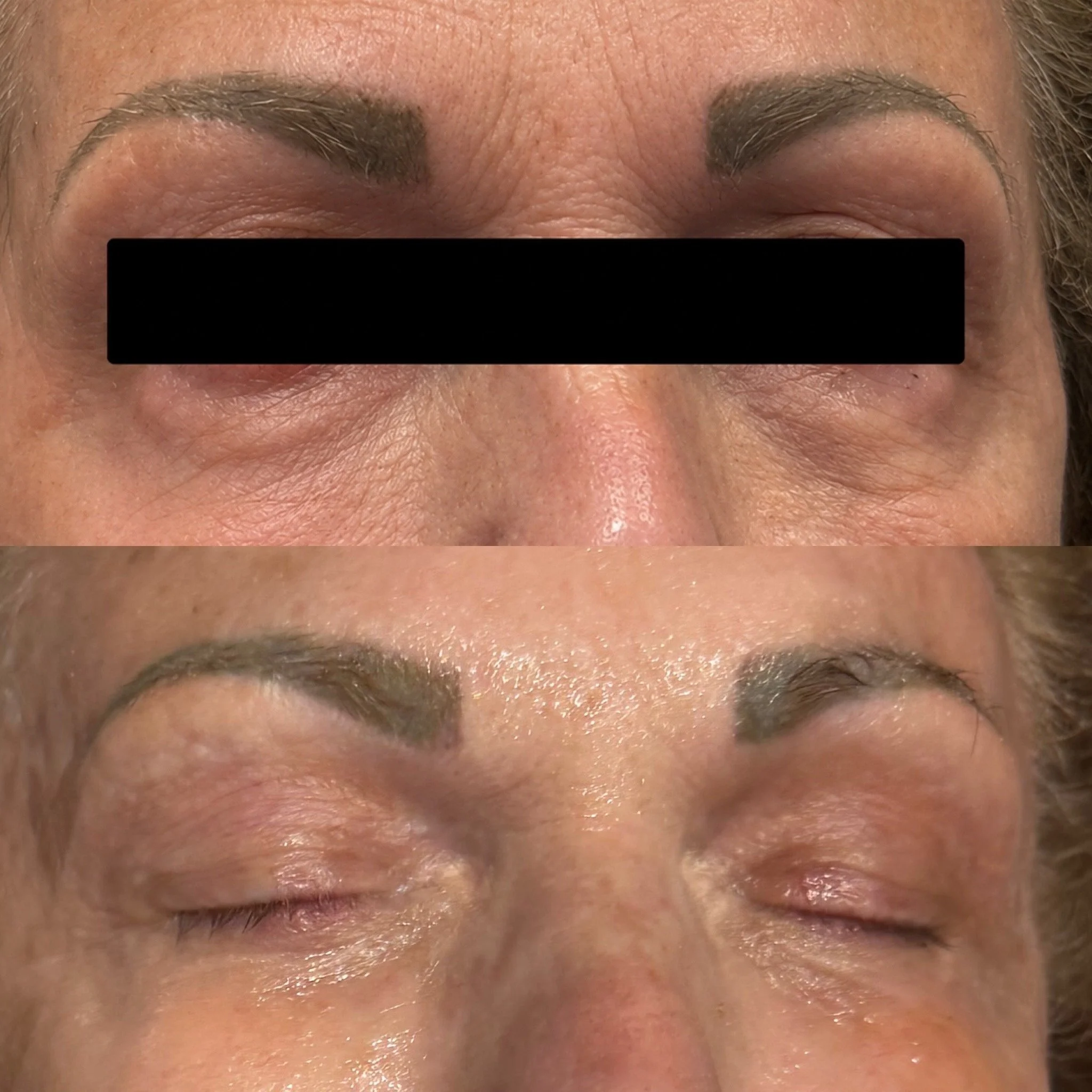 78-Year-Old Female | Low-Energy Plasma | Lower Eyelids | 3 Treatments