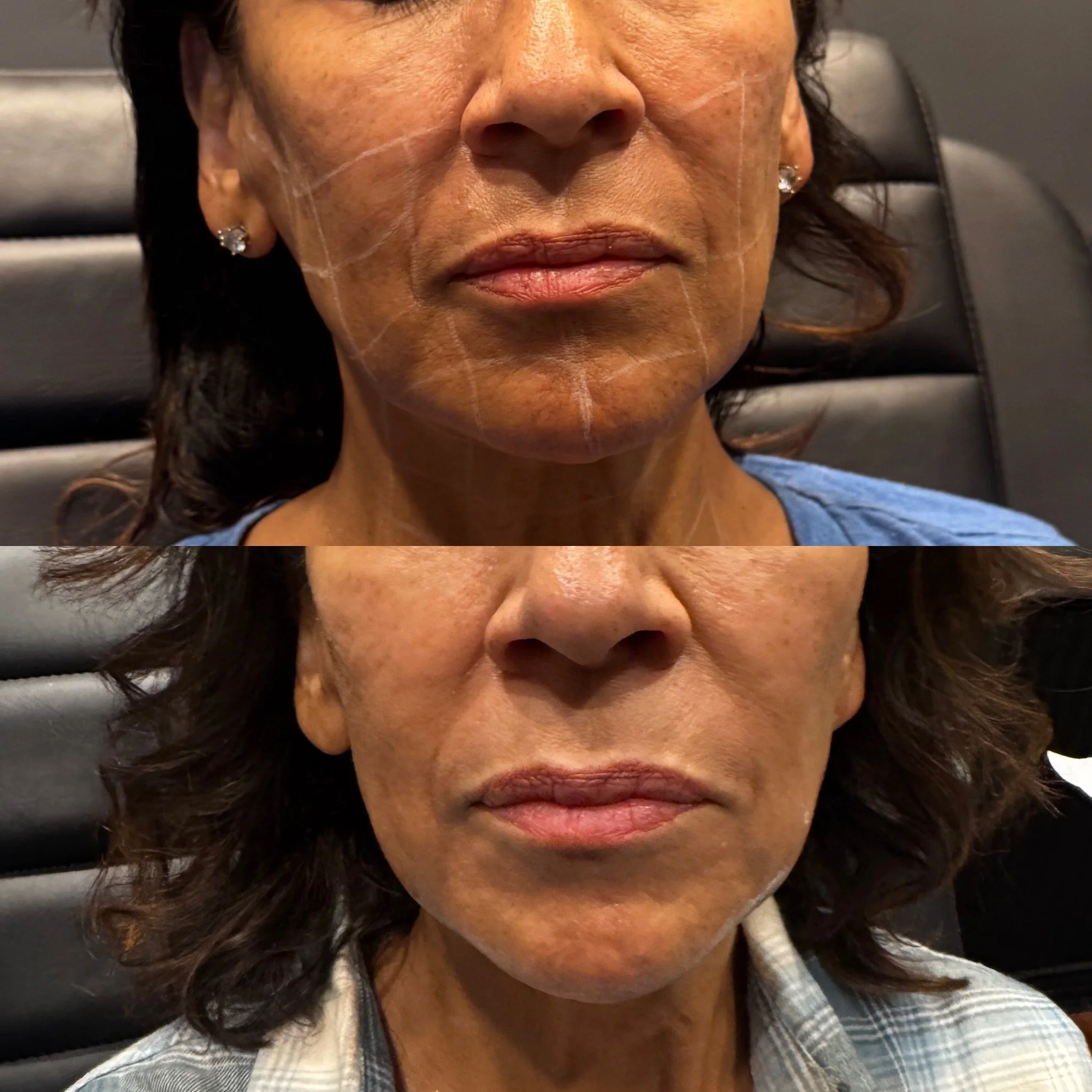 67-Year-Old Female | Low-Energy Plasma | Low Face & Neck | 4 Treatments