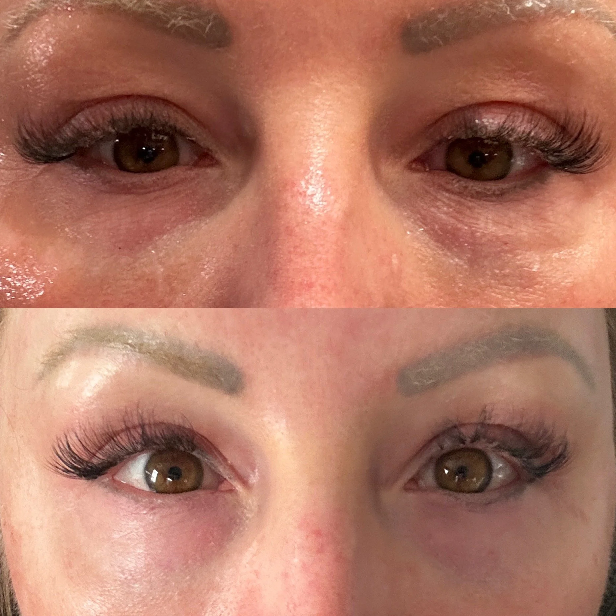 44-Year-Old Female | Low-Energy Plasma | Upper & Lower Eyelids | 1 Treatment.