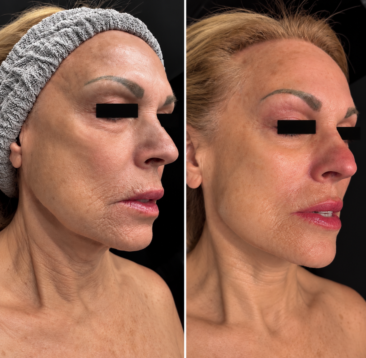 78-Year-Old Female | Low-Energy Plasma | Jaw & Lower Face | 3 Treatments