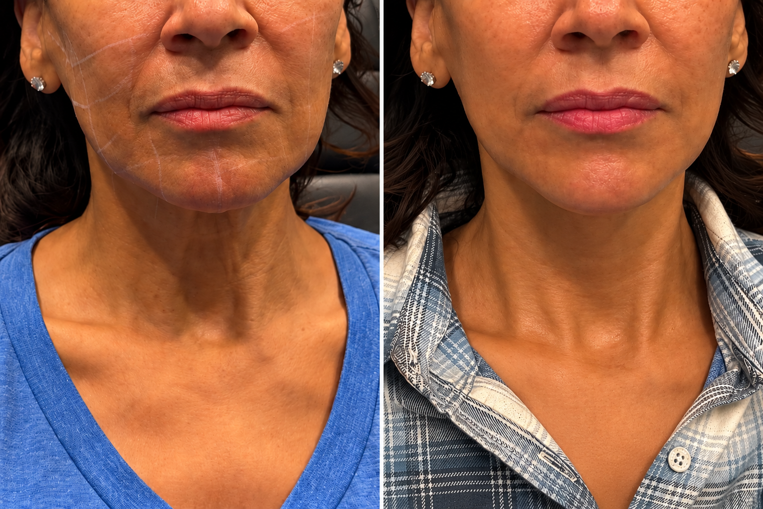 67-Year-Old Female | Low-Energy Plasma | Low Face & Neck | 4 Treatments