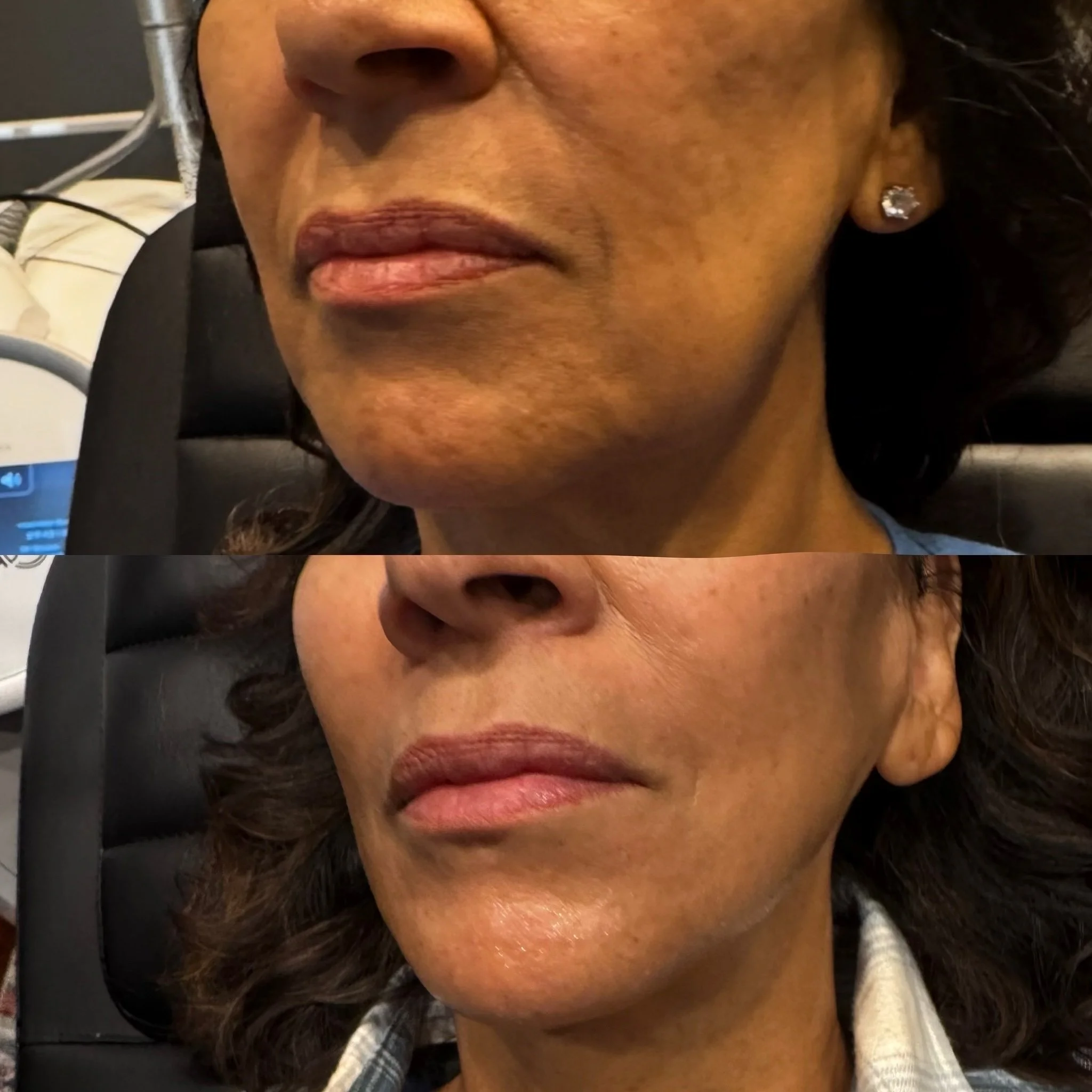 67-Year-Old Female | Low-Energy Plasma | Low Face & Neck | 4 Treatments