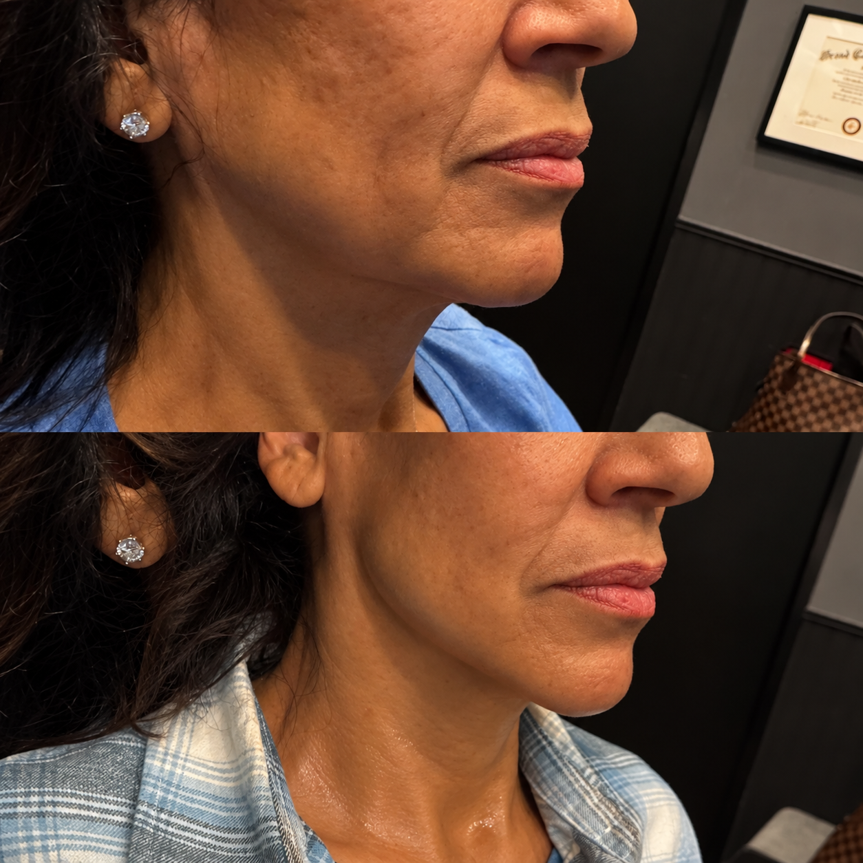 67-Year-Old Female | Low-Energy Plasma | Low Face & Neck | 4 Treatments