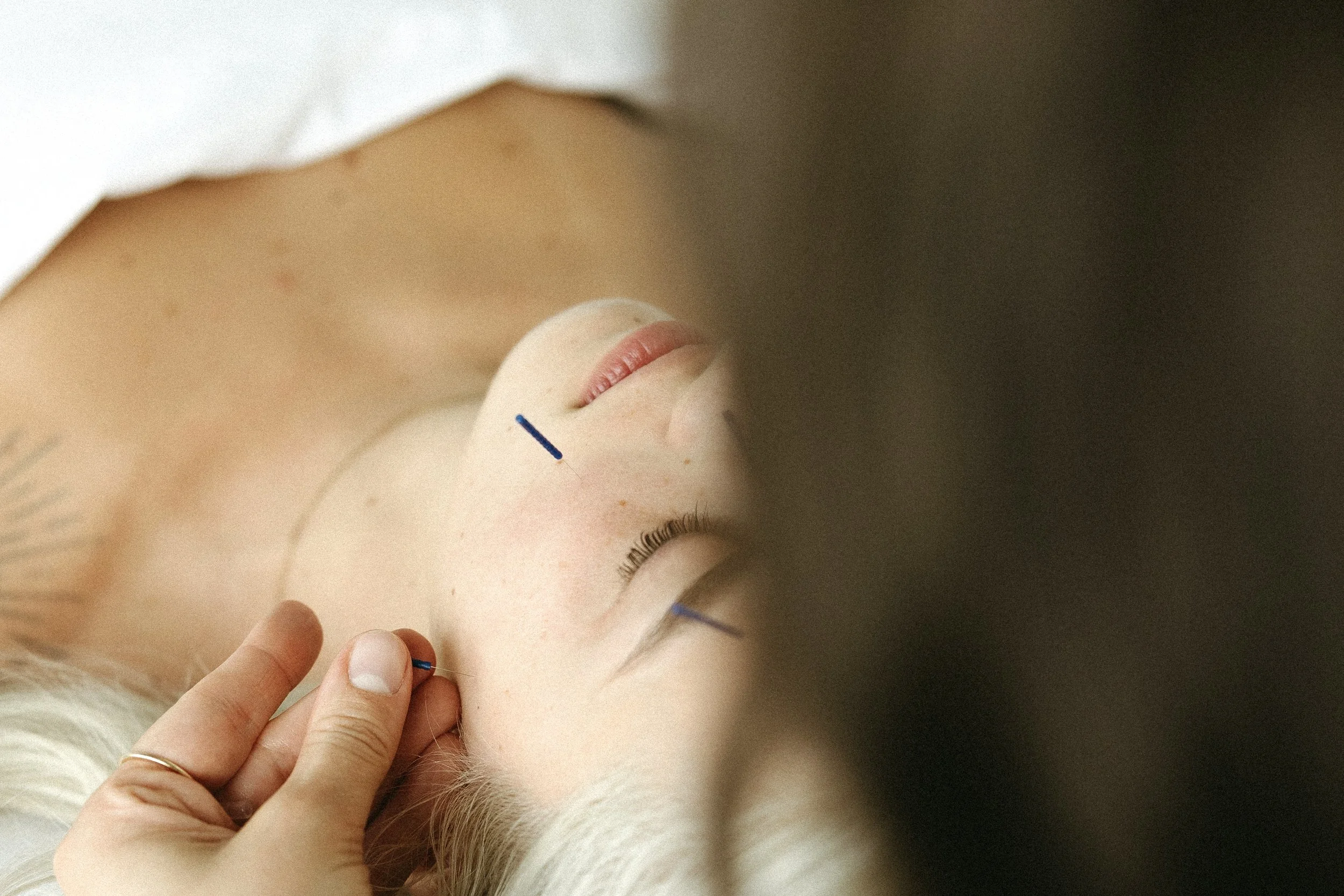 How Acupuncture Supports You At Every Stage