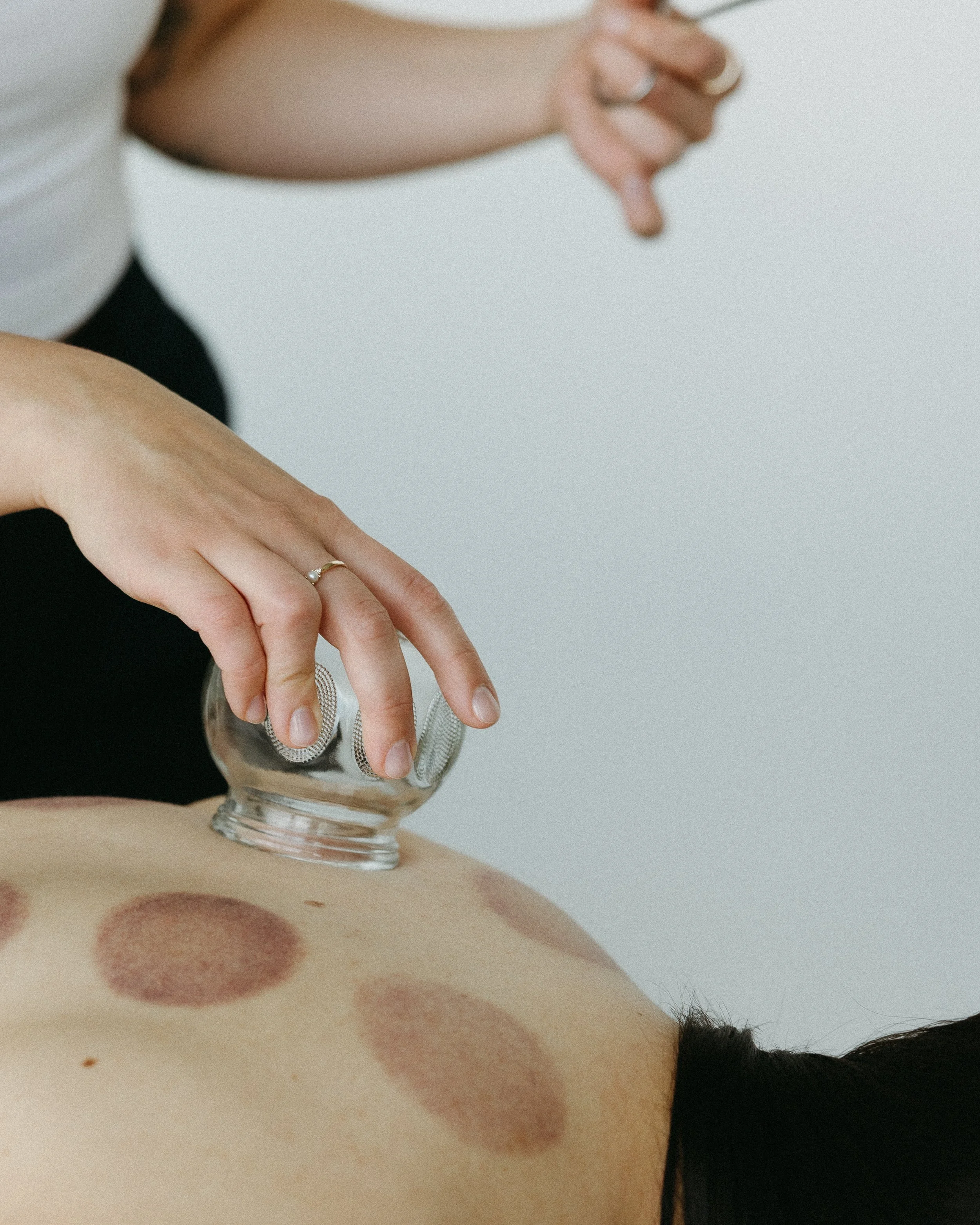 Fire Cupping 101: A Beginner’s Guide