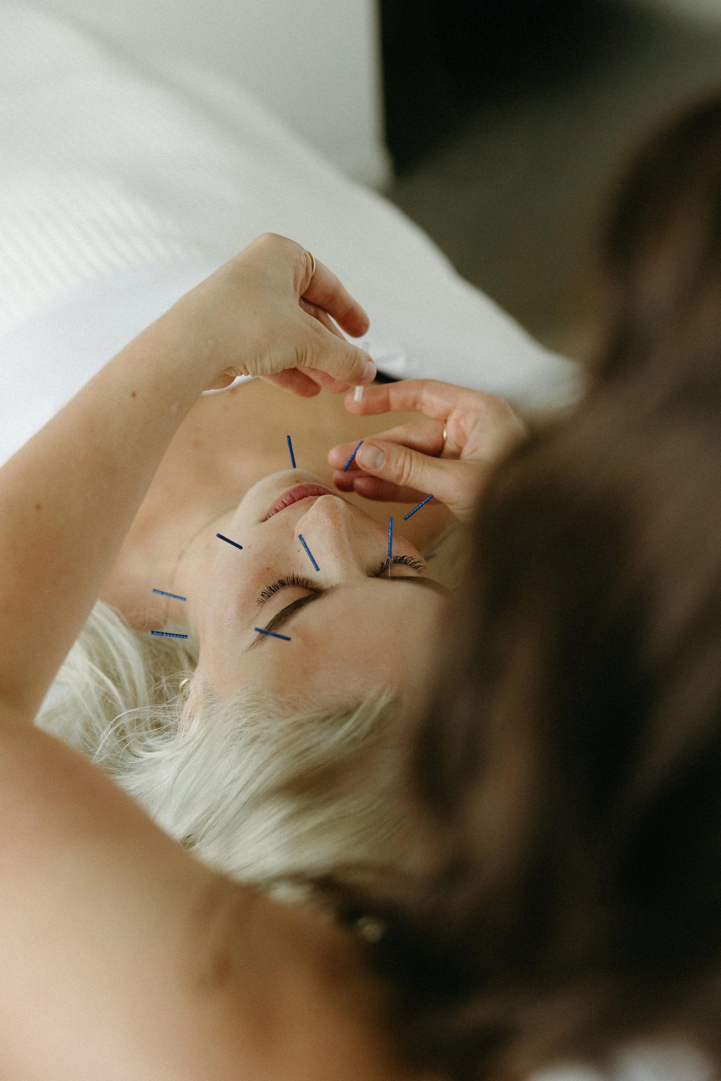 cosmetic acupuncture calgary