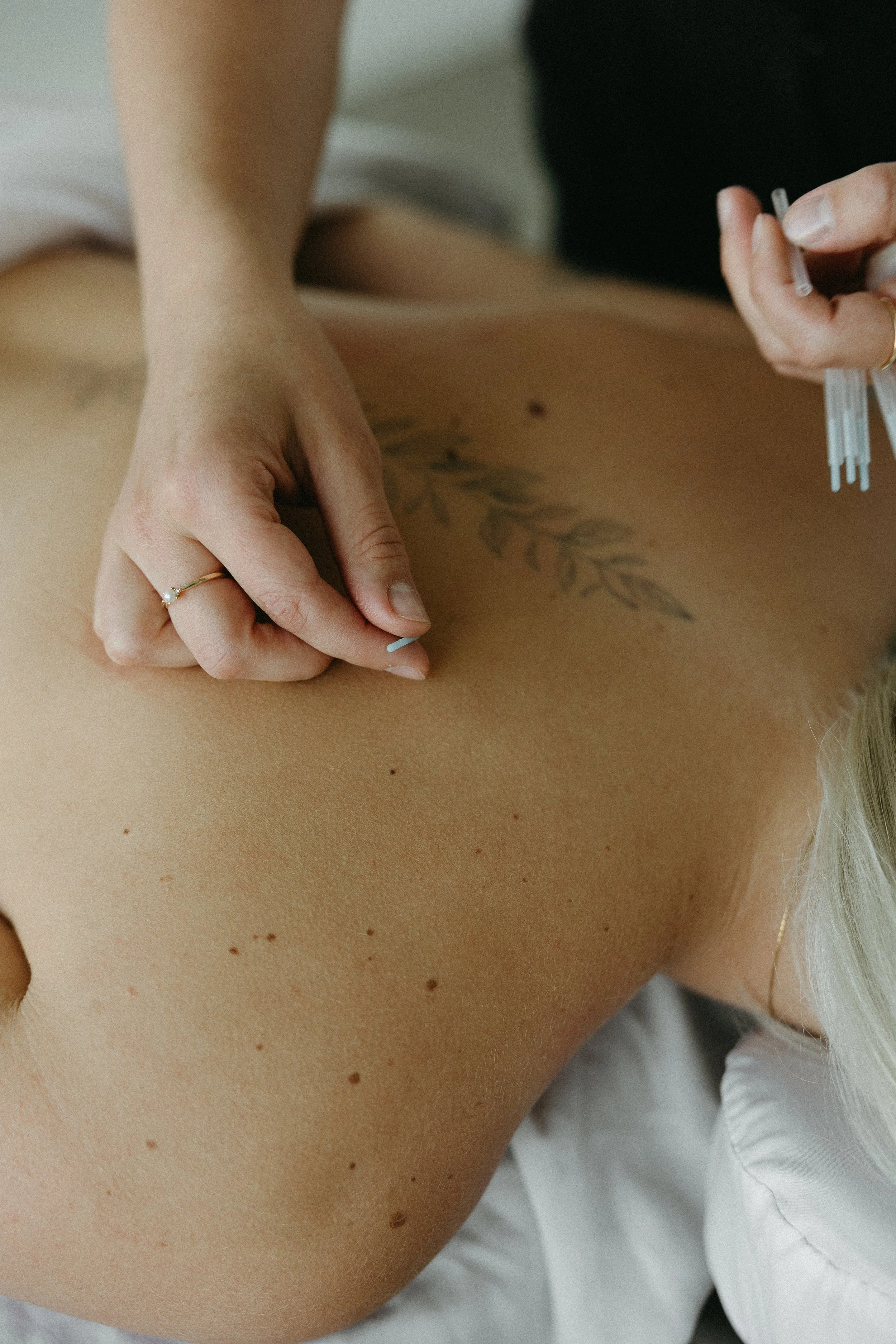 acupuncture calgary