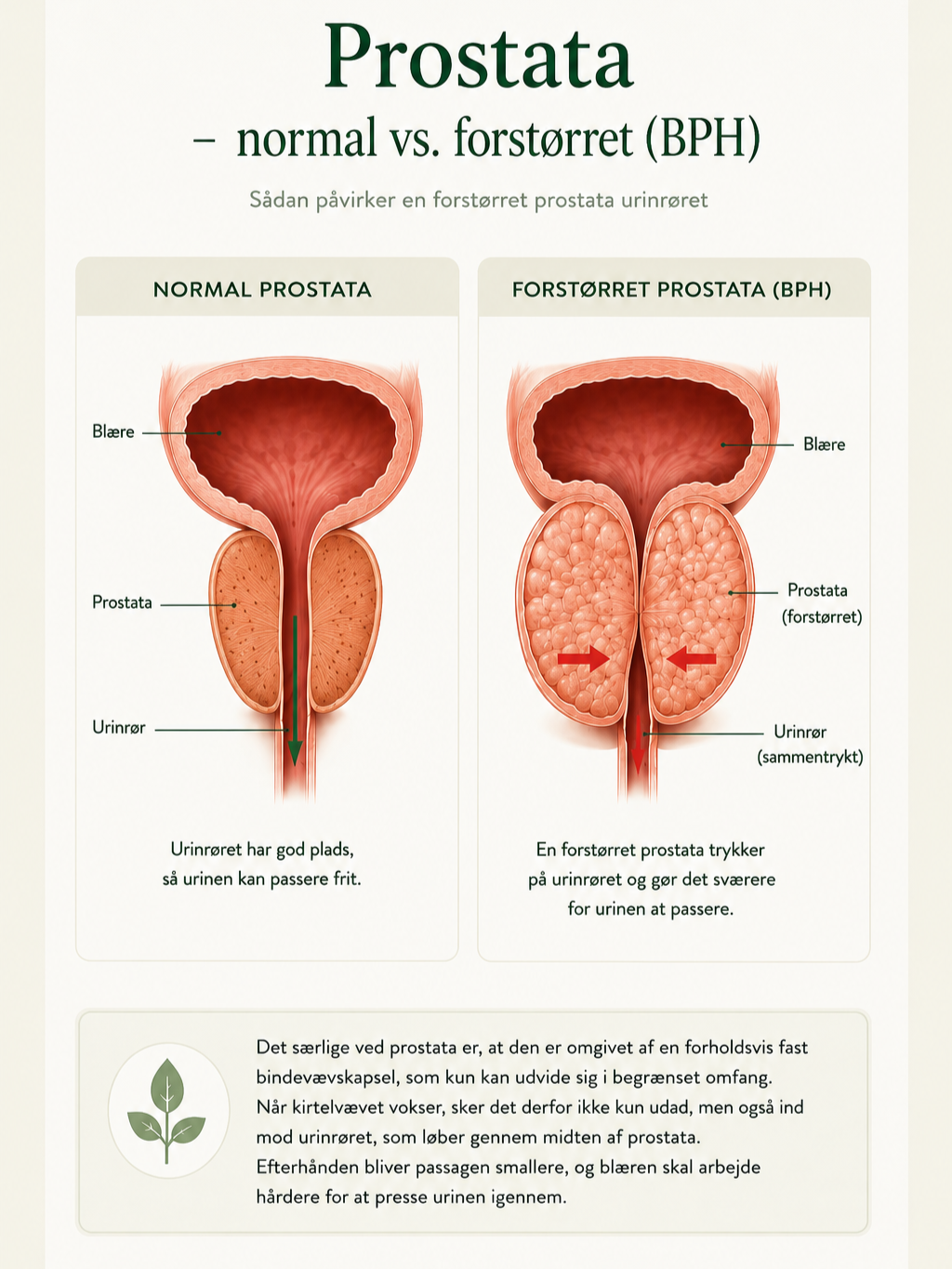 Illustration af normal og forstørret prostata (BPH), der viser hvordan en forstørret prostata kan indsnævre urinrøret.