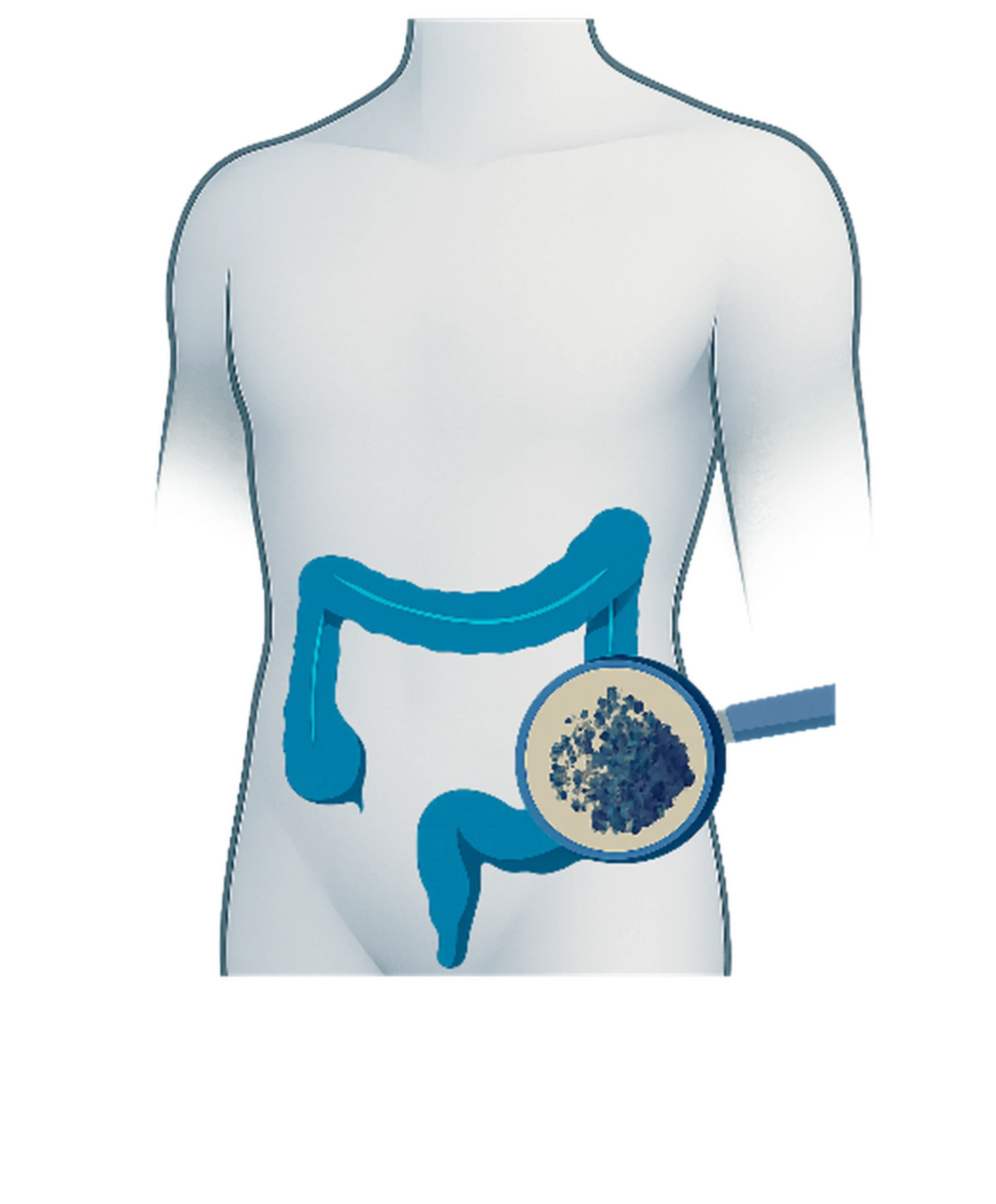 Colorectal cancer illustration of human torso showing colon, rectum, large intestine and digestive system anatomy with tumour cells highlighted