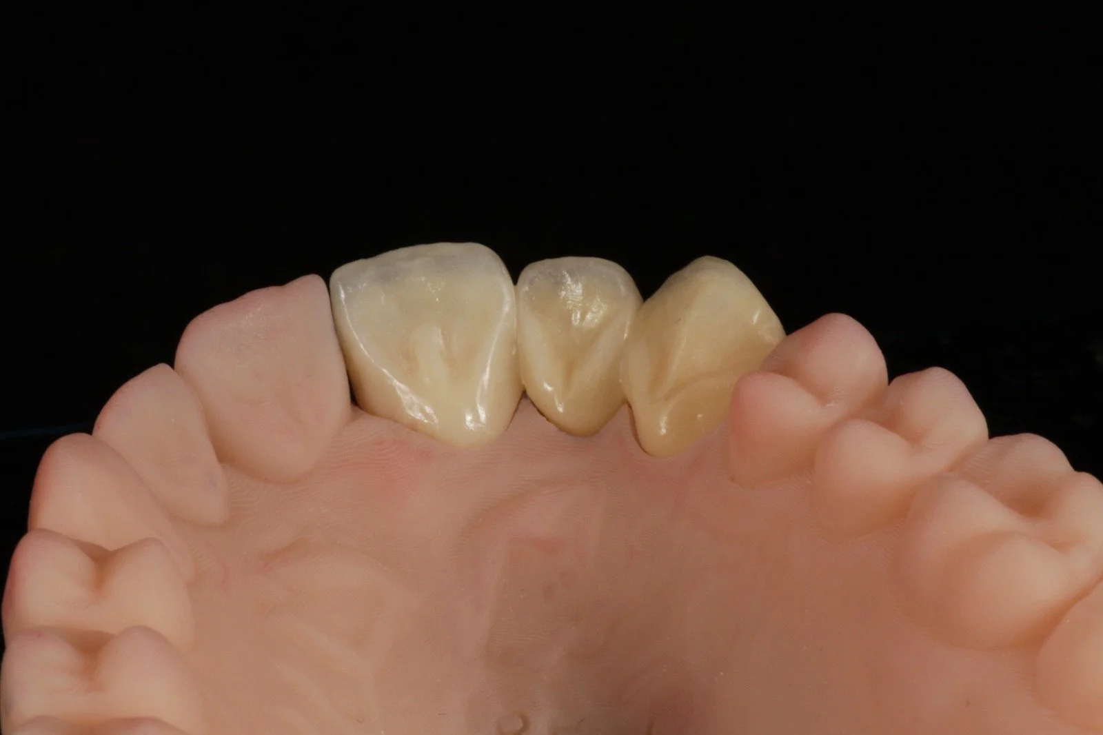 Close-up of a set of molar teeth on a model, showing the top view of the upper jaw with three molars and surrounding gums.