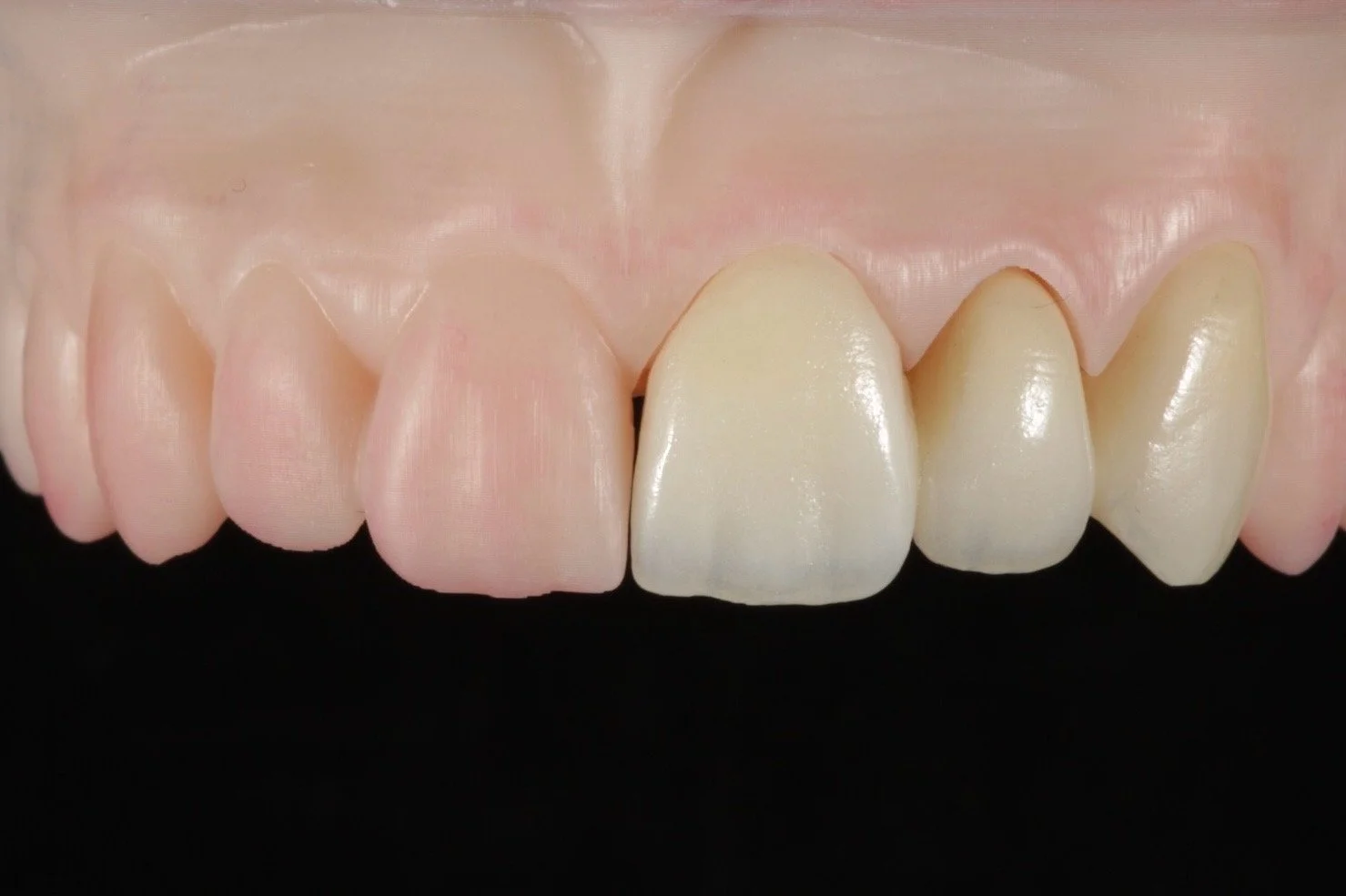 Close-up of upper front teeth, including canines and incisors, with some teeth appearing artificial or possibly crowns.