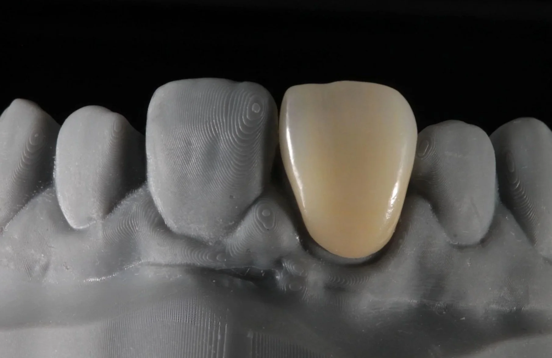Close-up of a dental mold showing a gold-colored dental crown on one tooth, with other teeth in gray color surrounding it.