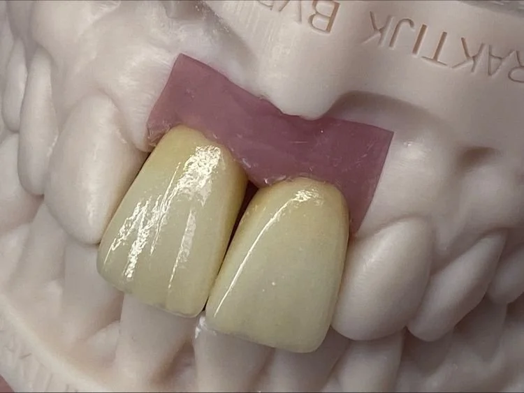 Dental model showing two front teeth and a pink gum line with a pink spacer or temporary dental material above the teeth.
