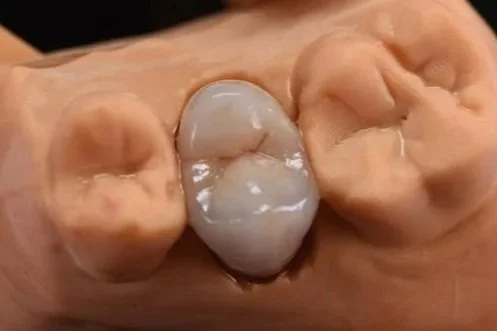 Tandheelkundige behandeling met een tandfiller of vulling in een kies.