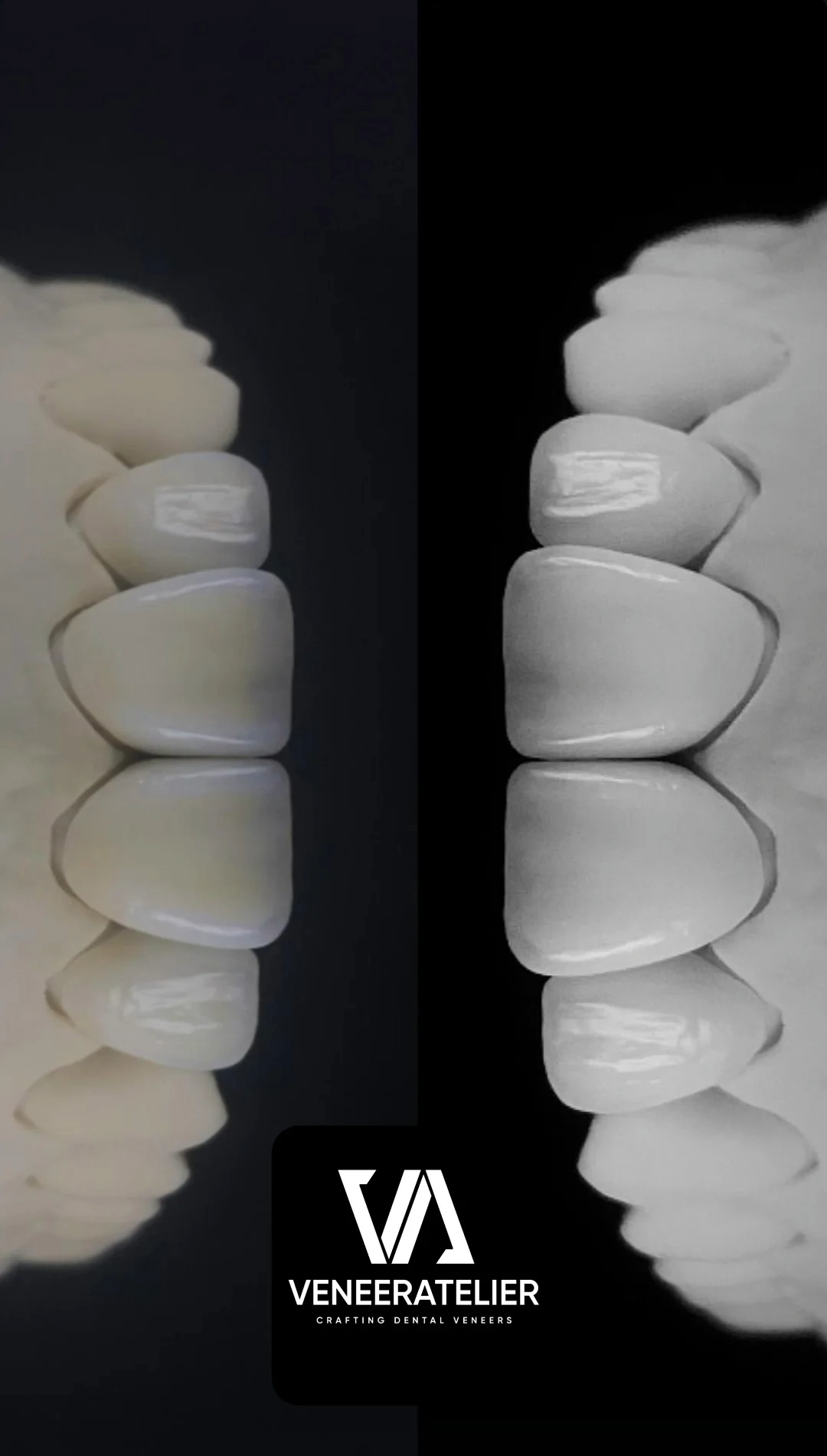 Side-by-side comparison of teeth veneers, with the left set in a darker setting and the right set in a lighter setting, featuring a black background with VENEратelier branding and the tagline 'Crafting Dental Veneers'.