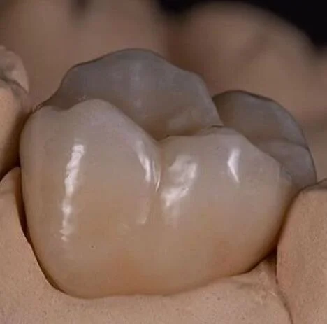 Close-up van een gebroken tand met een goudkleurige kroon.