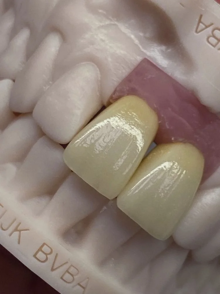 Close-up of artificial nail tips, featuring a design with yellow nails and a pink accent, on a white glove background.