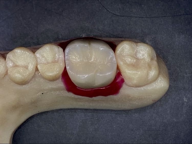 A dental model displaying a molar tooth with a crown, surrounded by blood or red-colored material.