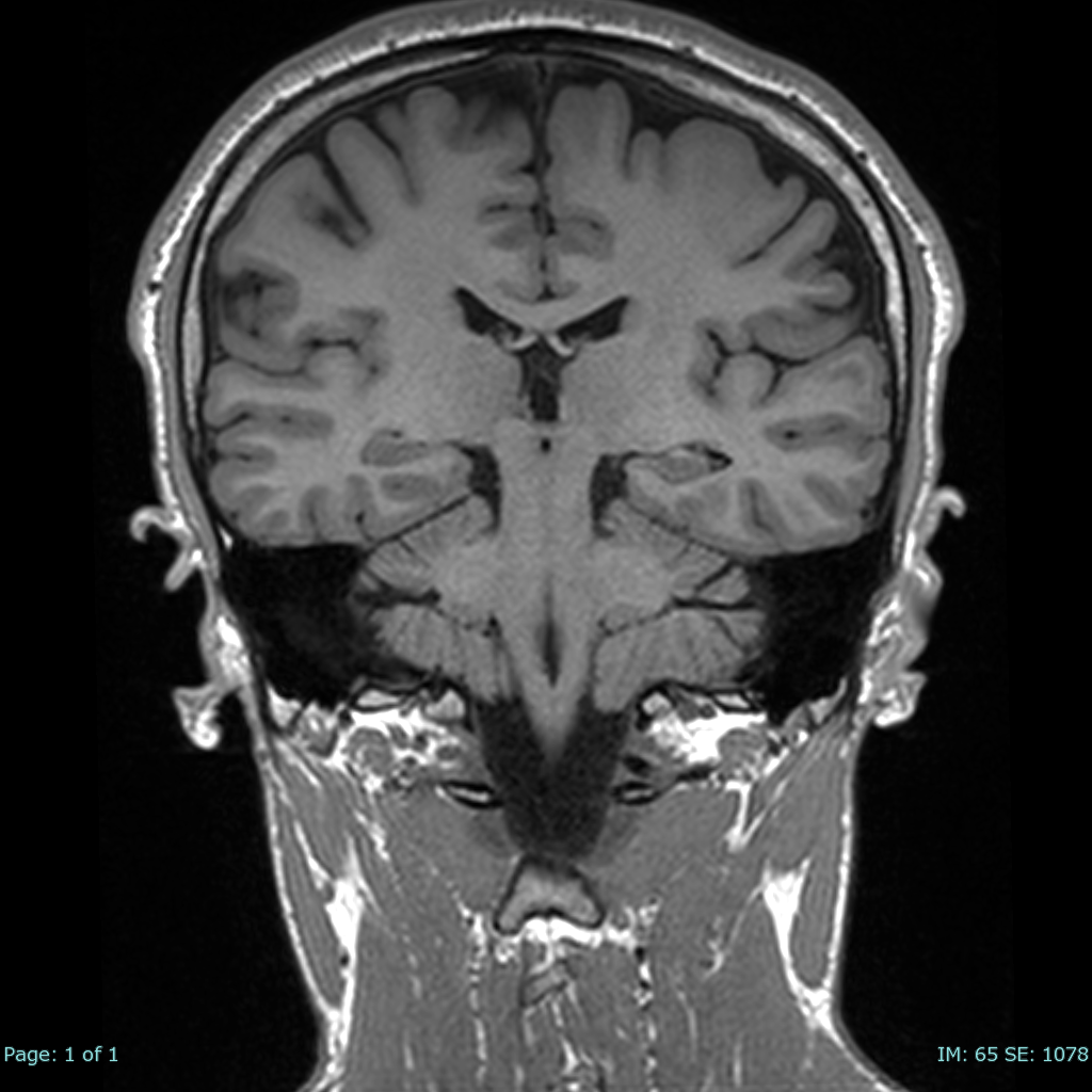 202604260021901_MPR 1mm_0064.png