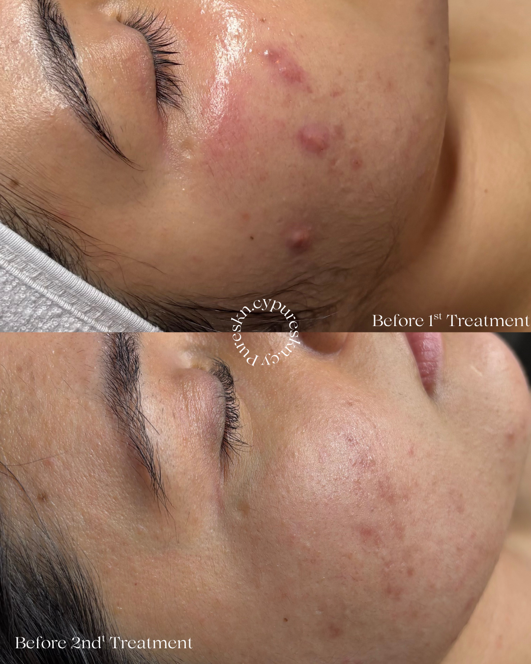 Side view of a person's face showing skin improvement after dermatological treatments. The top photo depicts skin with acne scars and inflammation before the first treatment, and the bottom photo shows clearer, smoother skin after the second treatment.