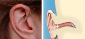 Side-by-side image of a human ear and a diagram of an ear canal with an open fit receiver-in-canal hearing aid