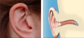 Comparison of a human ear and a diagram of a receiver-in-canal hearing aid in the ear canal