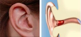 Composite image of a human ear and a diagram of ear canal with a completely-in-the-canal hearing aid.