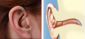 Comparison of a human ear with a hearing aid and a diagram of an in-the-canal hearing aid.