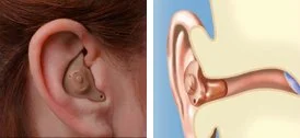 Side-by-side comparison of an ear wearing a full shell in-the-ear hearing aid and an anatomical illustration of the ear with a full shell in-the-ear hearing aid fitted.