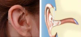 Close-up of an ear with a behind-the-ear hearing aid, and a cross-section diagram of an ear with the hearing aid inserted.