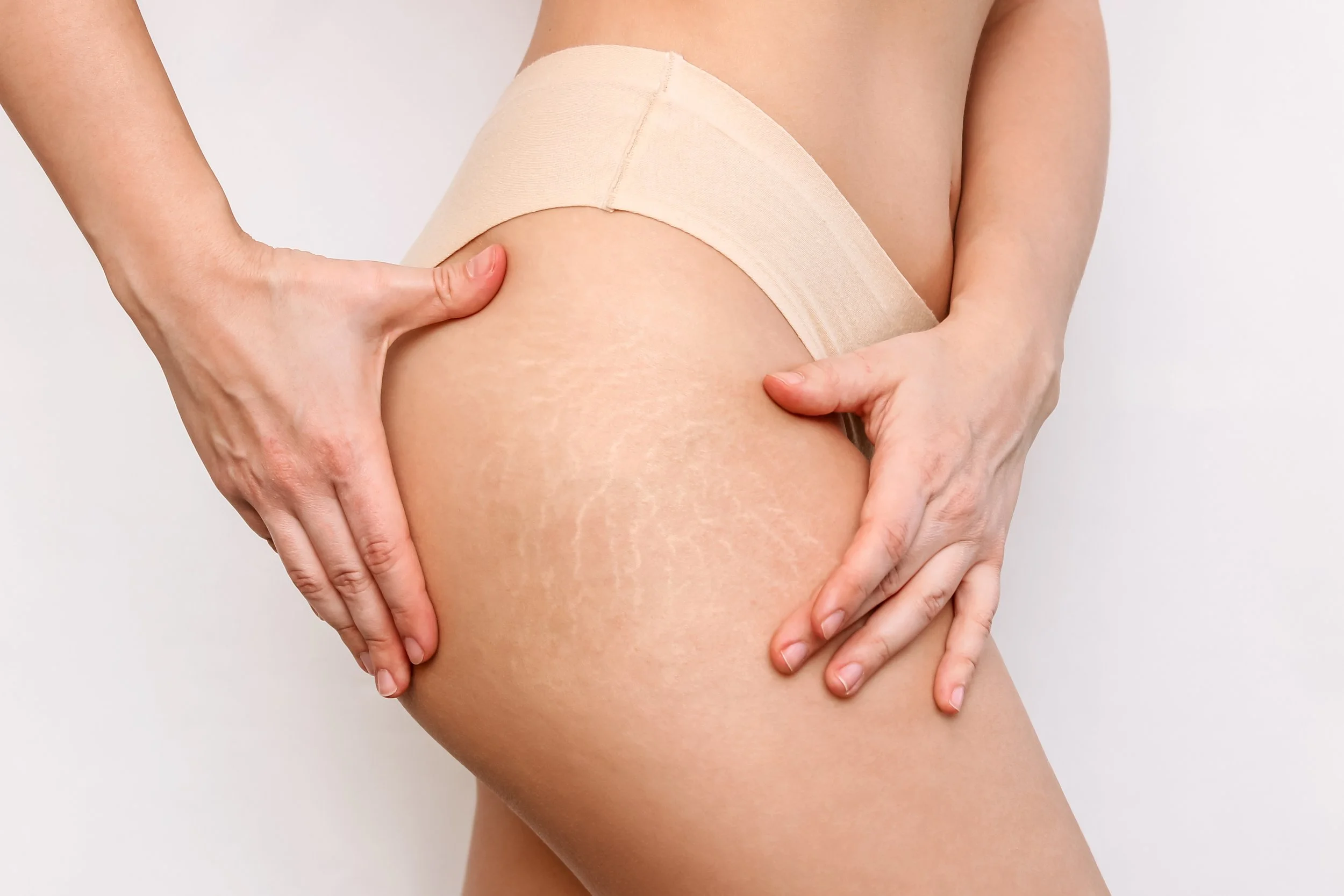A person pulling their beige underwear to the side, showing their thigh and hip with stretch marks on the skin.