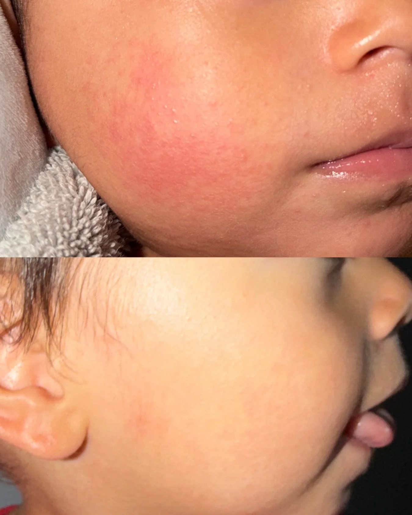 Not all skincare is safe for sensitive, inflamed skin&hellip; but this is 🤍

This is a 3-day transformation using the SIV Biome Balancing Serum + GlyMed Plus Comfort Cream on heat rash + inflamed, compromised skin.

As an esthetician, I&rsquo;m extr