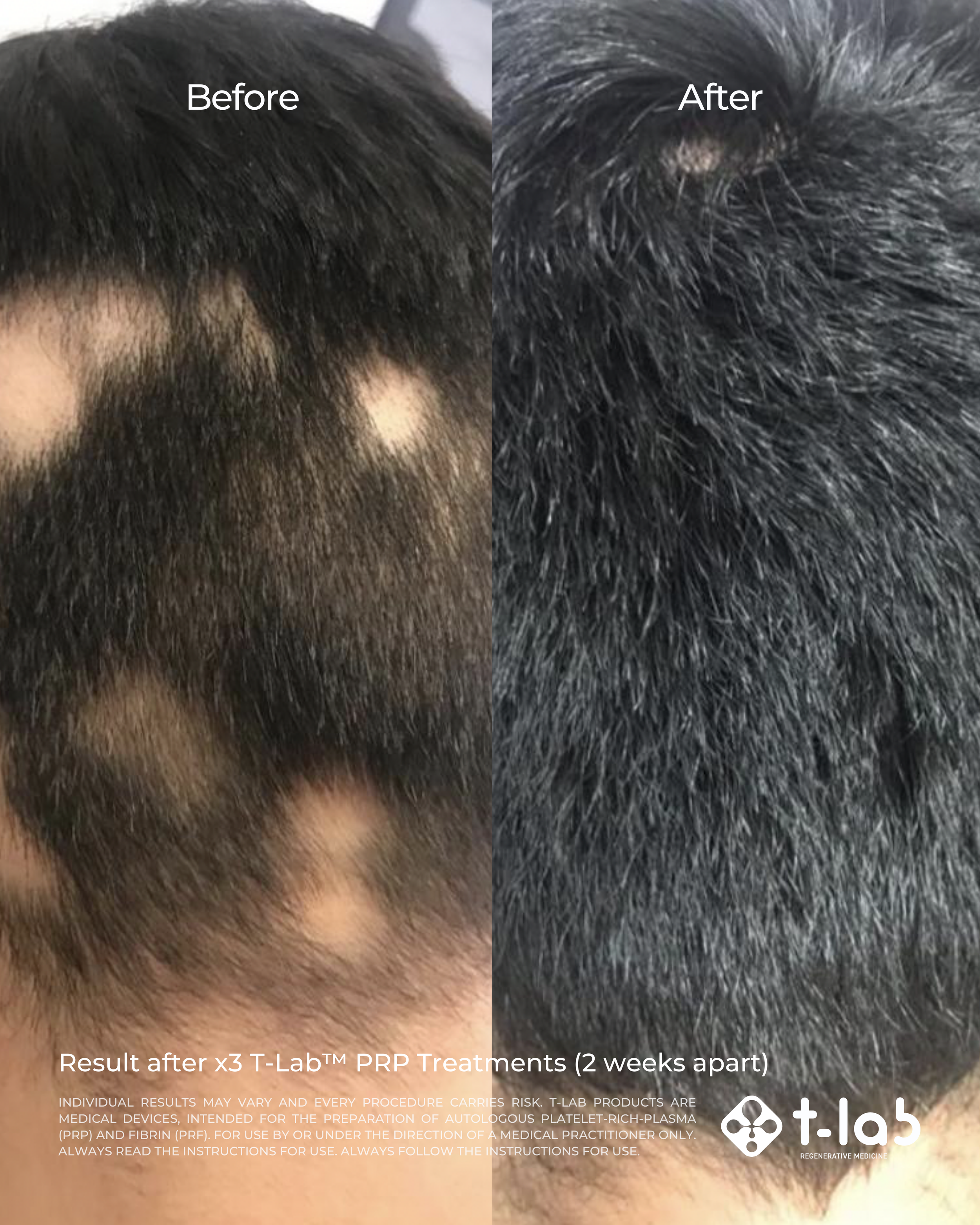 Platelet-Rich Plasma (PRP) — InnovaSkin Studio