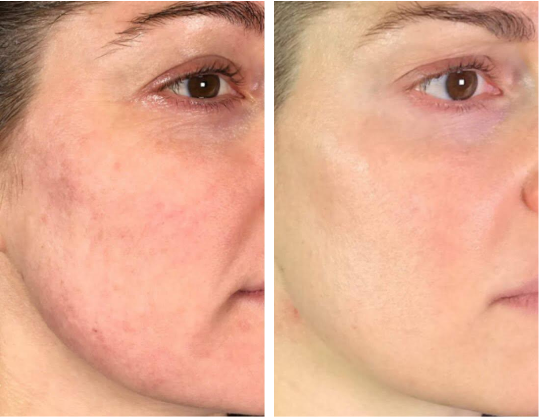 Exosome with Skin Needling x 3 Series