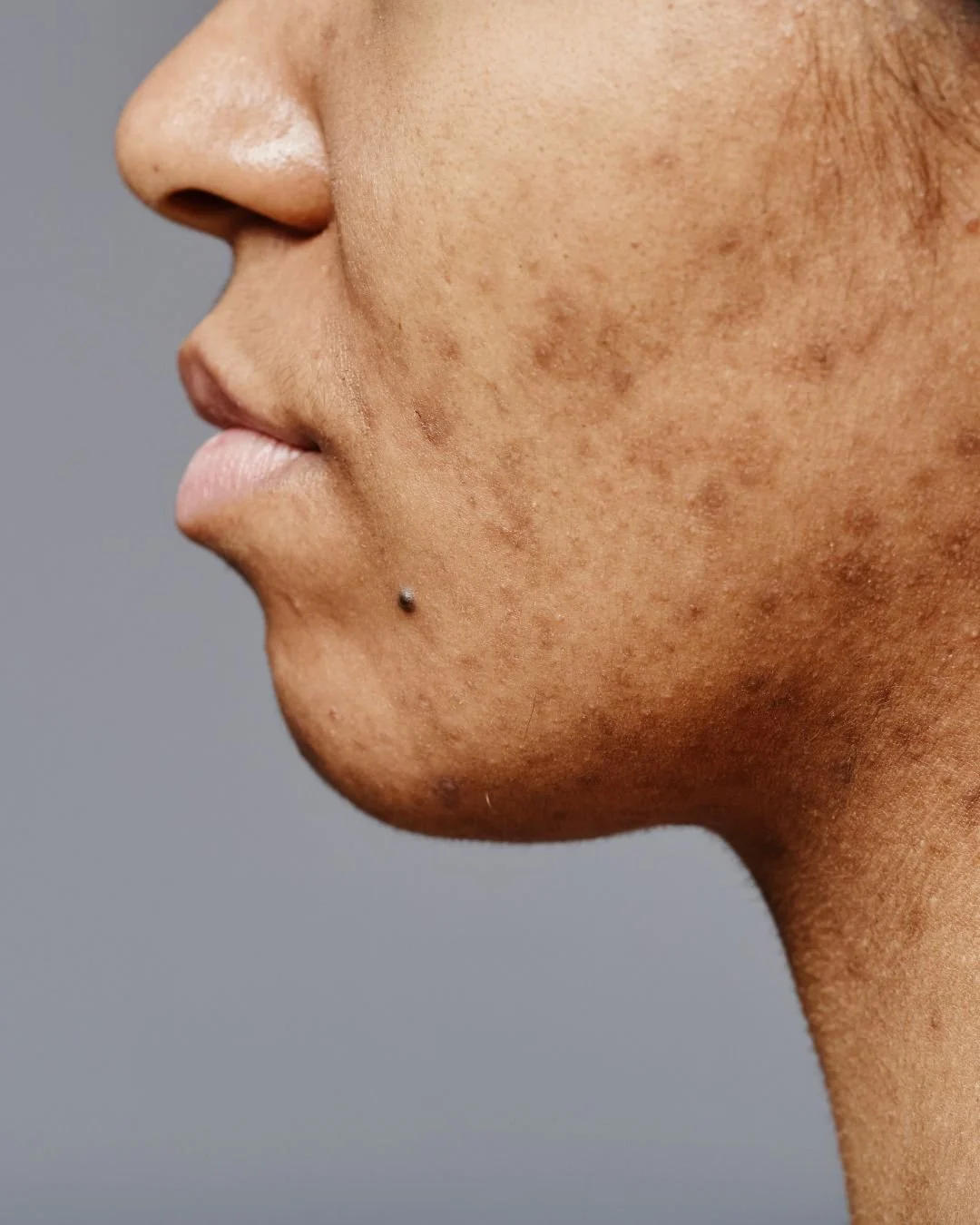 Close-up side profile of a person's face showing brown skin with hyperpigmentation and a small mole near the chin.