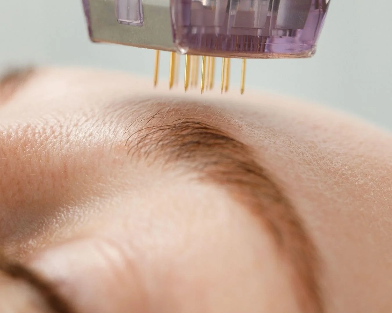 Close-up of a person's eyebrow and skin, with a cosmetic or medical device with multiple fine pins positioned above the eyebrow.