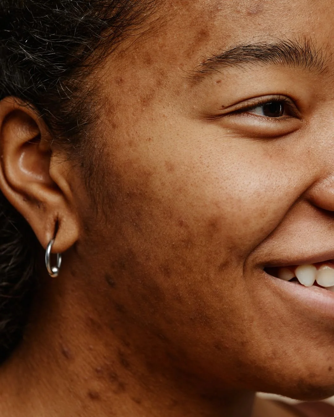 Close-up of a smiling woman's face showing her ear with a small hoop earring, her cheek, and part of her eye, with visible skin texture and blemishes.