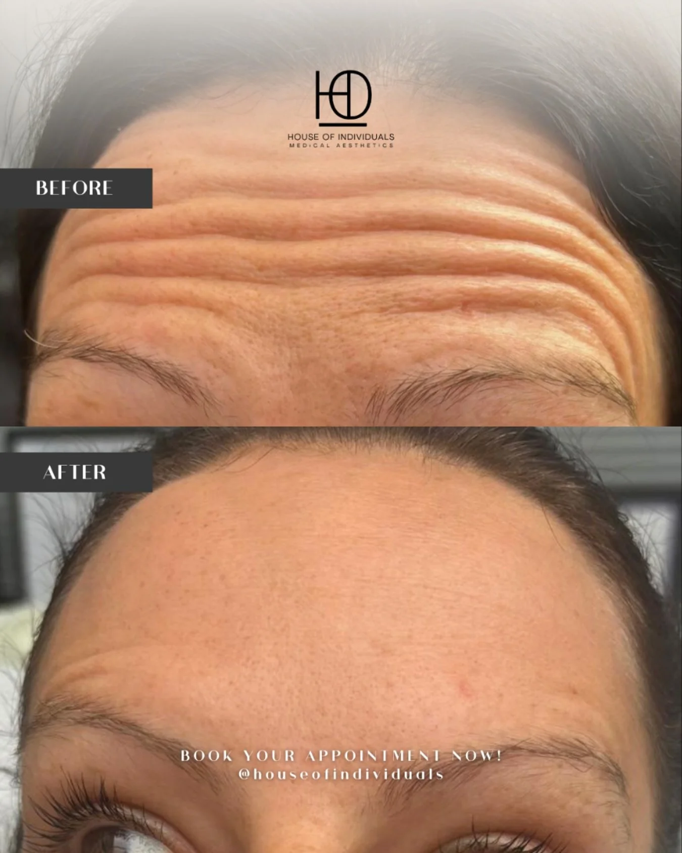 ✨ Smooth, refresh, and restore ✨
My anti-wrinkle treatments are designed to soften fine lines and refresh your look without changing who you are 💎

💉 Quick and comfortable appointments
🌟 Natural results that keep expression
👌 Confidence that last