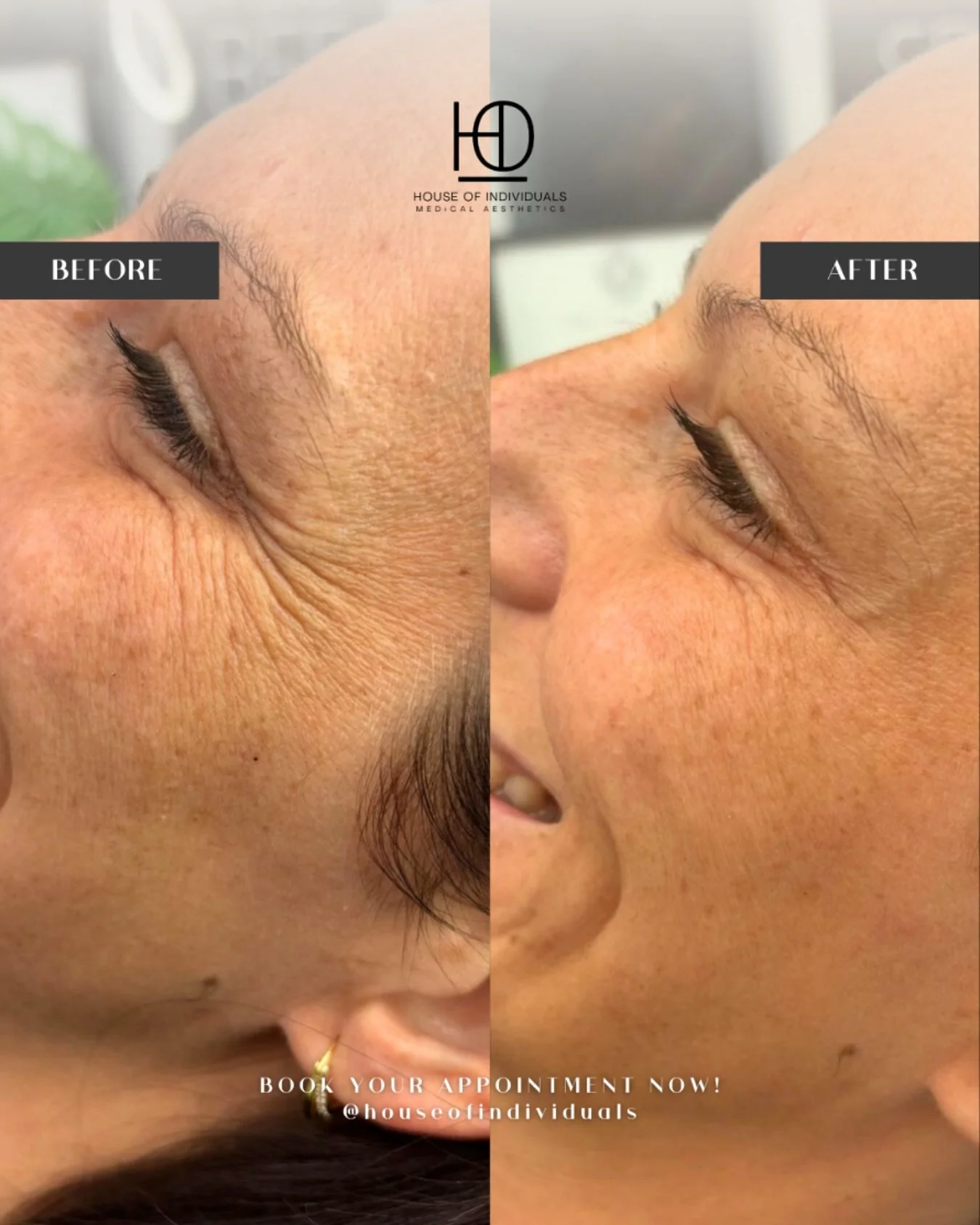 ✨ Smile with confidence, not with lines ✨

Crow&rsquo;s feet often show up first because the skin around our eyes is so delicate, but anti-wrinkle treatments can smooth them without taking away your natural expressions 🌟

💎 Refresh tired-looking ey