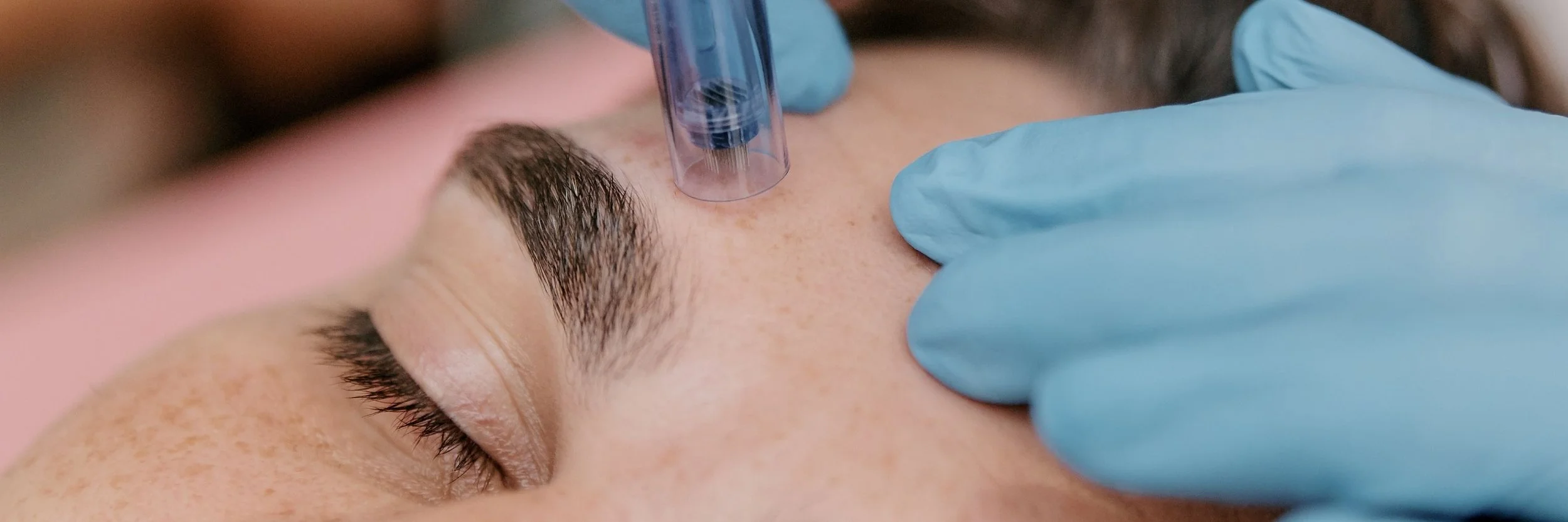 A person is receiving a cosmetic injection or treatment near the eyebrow while lying down, with nurse wearing blue gloves administering the procedure.