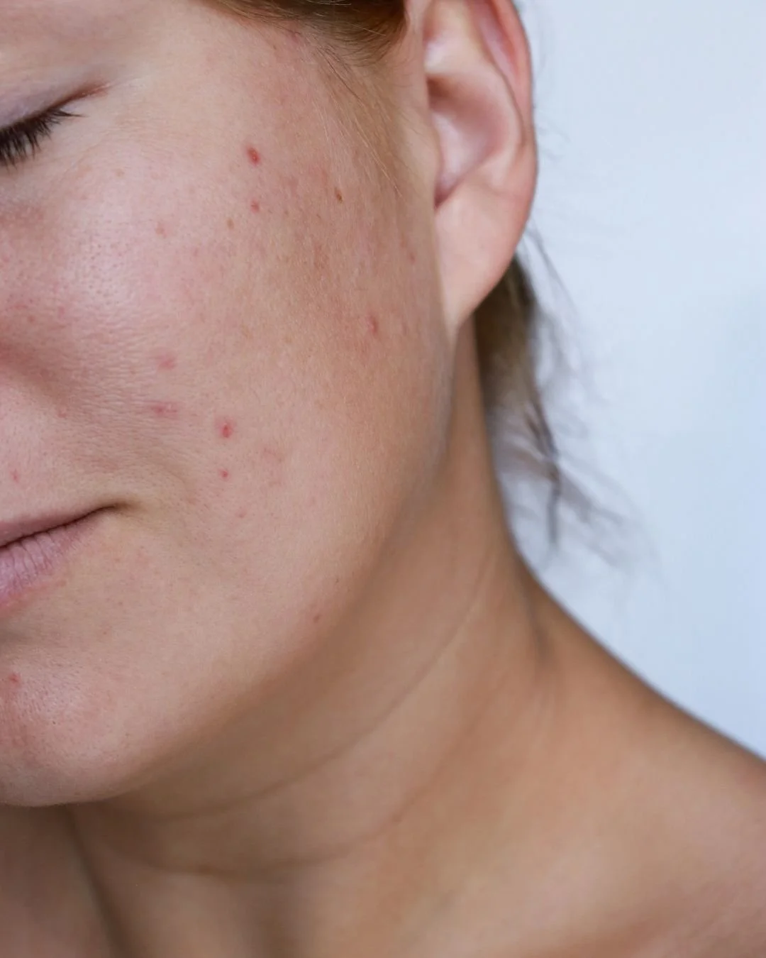 Close-up of a person's cheek and jawline showing acne and skin redness.
