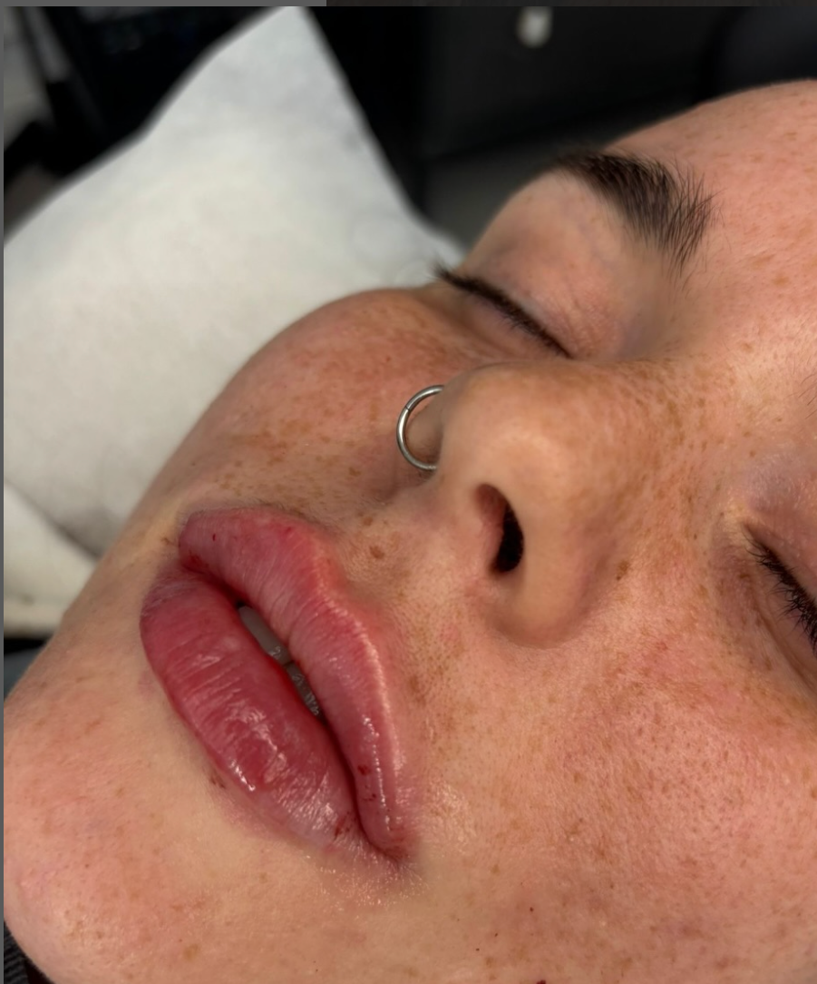Lips volumised from dermal filler treatments