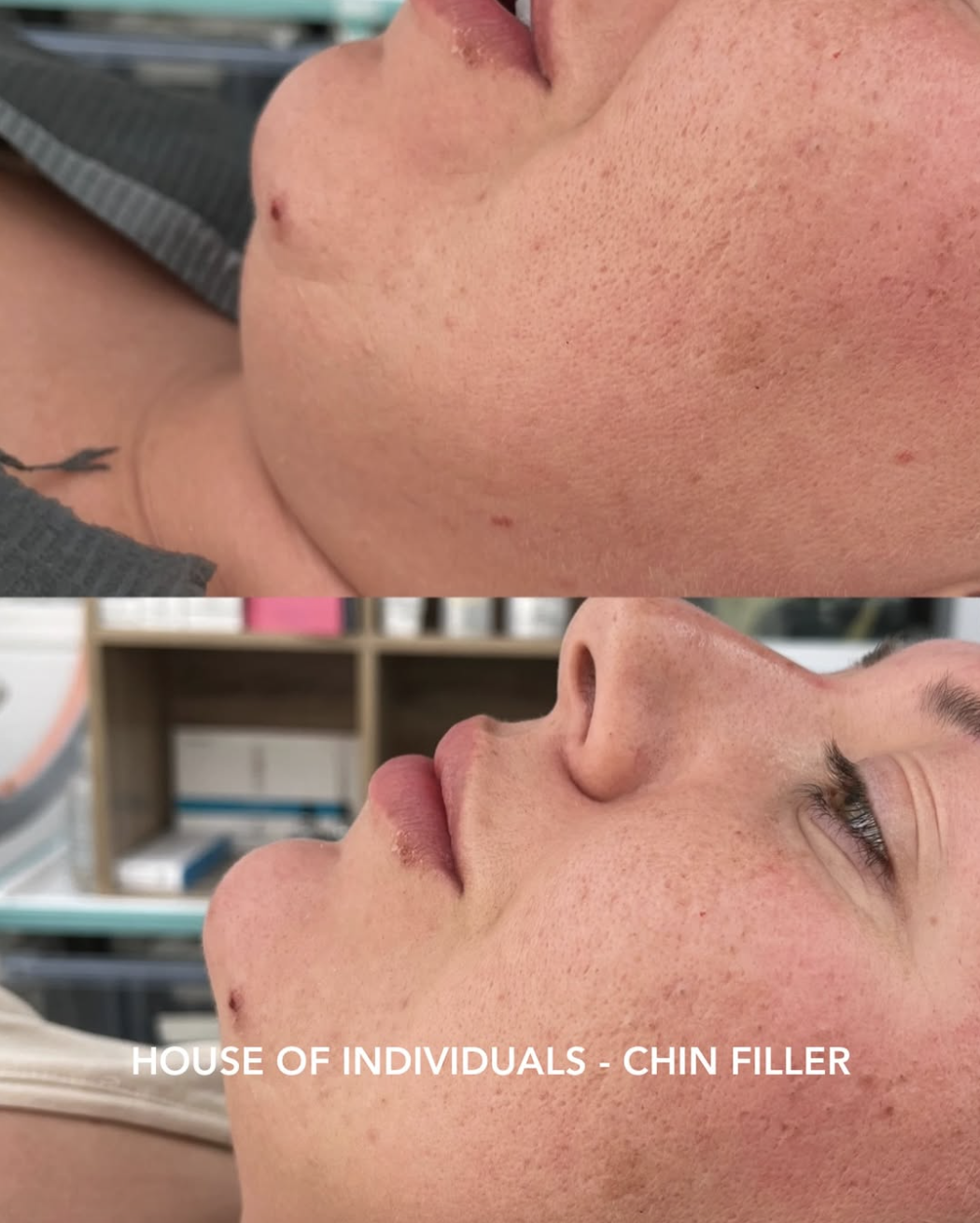 Before and After Chin Enhancements 1