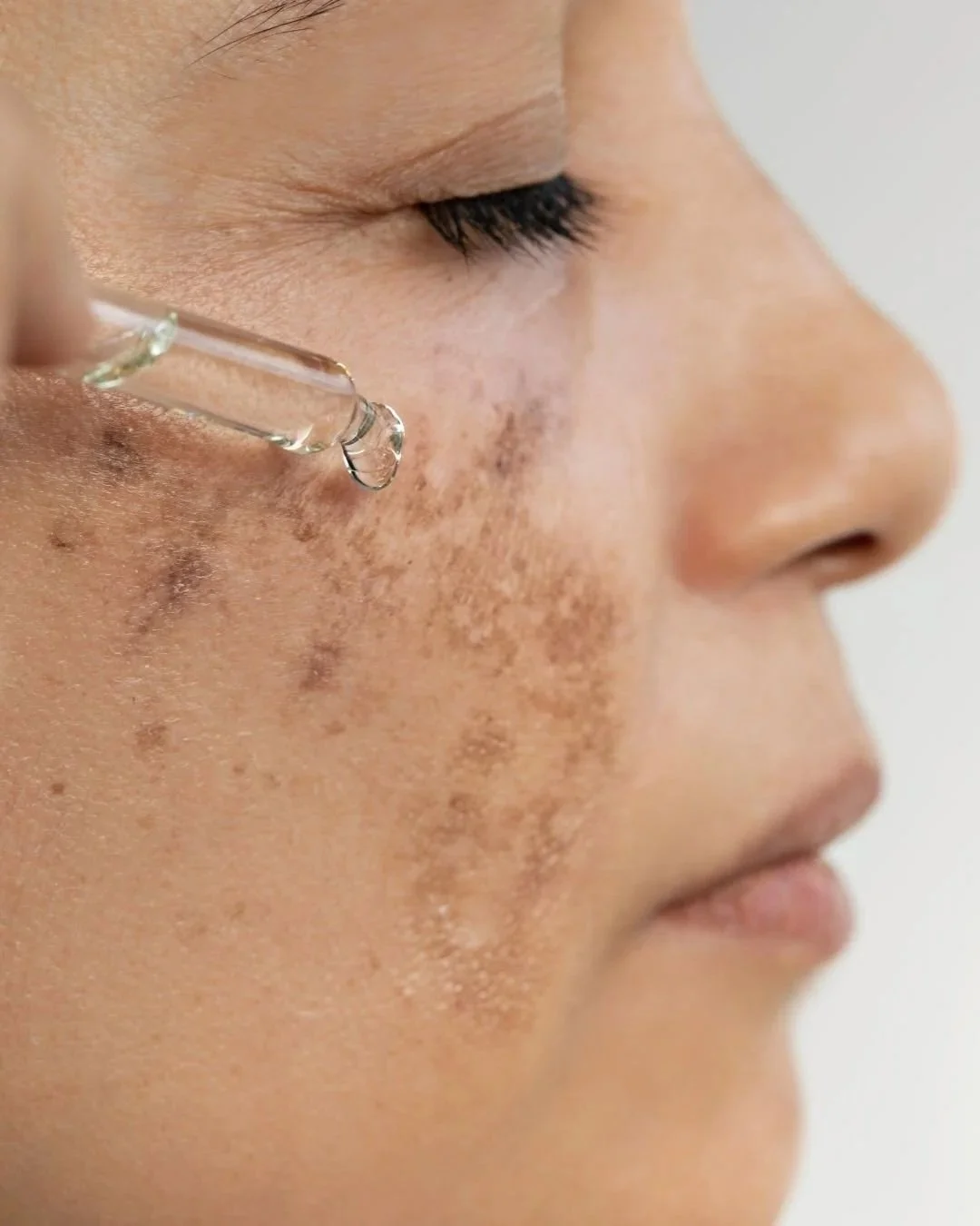 A woman with skin pigmentation concerns