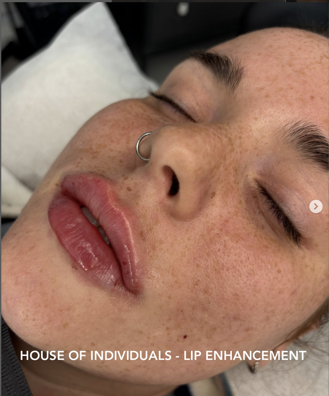 Before and After Lip Enhancements 2